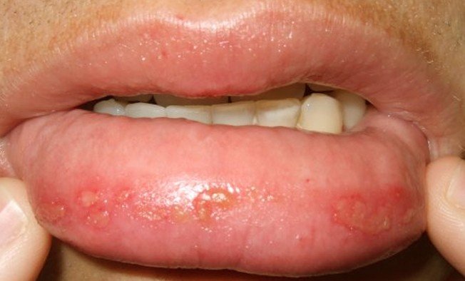 Bumps On Lips Causes Treatment Pictures 2018 Updated