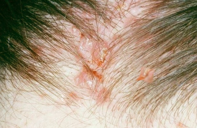 itchy bumps on scalp