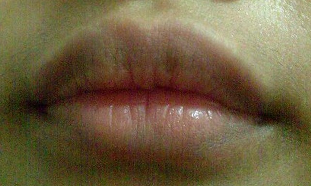 lip discoloration pictures 2
