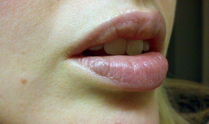 Lip Discoloration - Pictures, Causes, Treatment, Remedies 