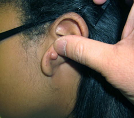 lump in earlobe pictures 3