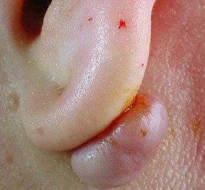 painful lump in earlobe