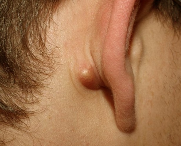 lump in earlobe