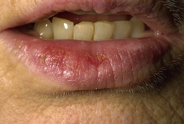 Sunburned Lips - Pictures, Symptoms, Treatment, Causes - (2018 - Updated)