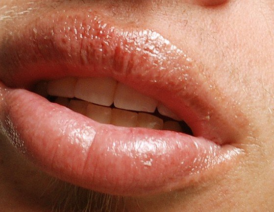 Sunburned Lips - Pictures, Symptoms, Treatment, Causes - (2018 - Updated)