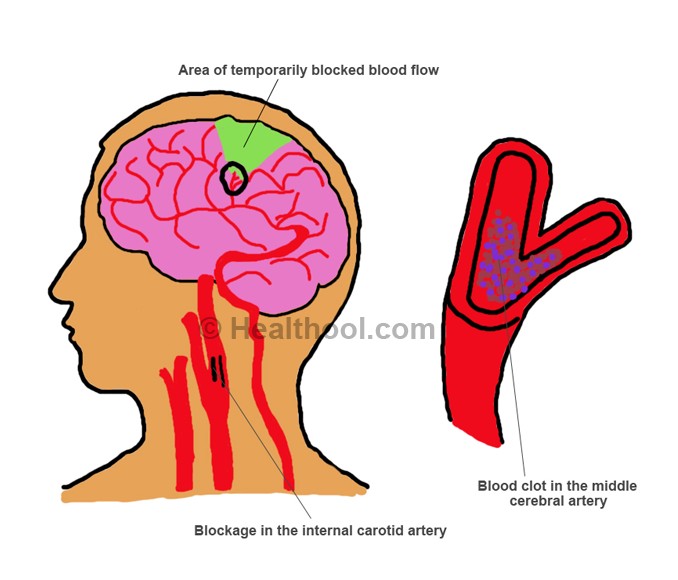 blood clots in the brain