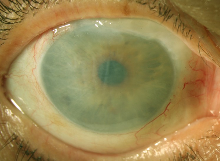 corneal edema pictures