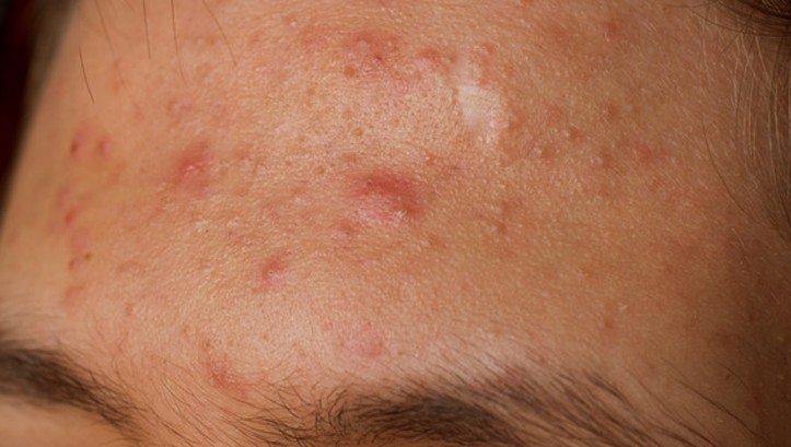 Forehead Acne Pictures Causes And Treatment 2018 Updated 