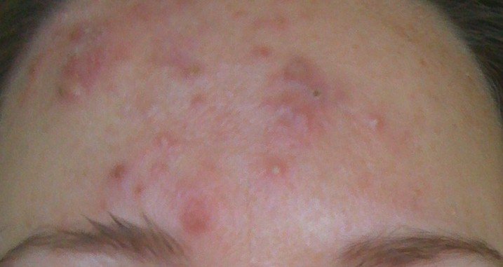 Forehead Acne Pictures Causes And Treatment 2018 Updated