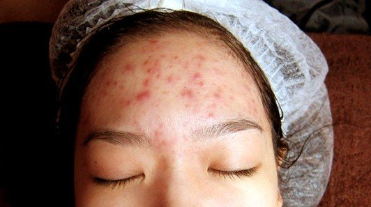 forehead acne