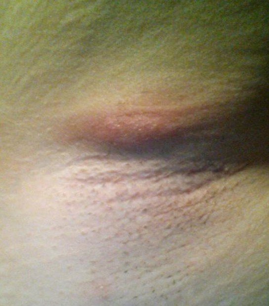 painful lump under the armpit