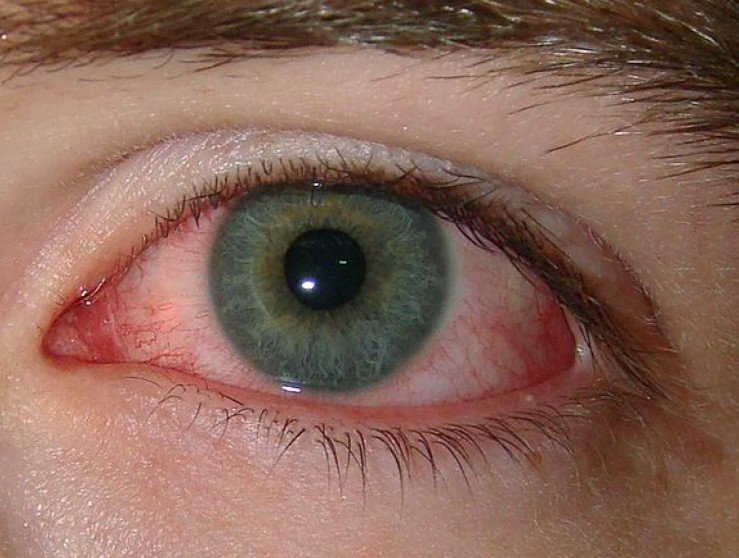 scratched-eye-symptoms-home-treatment-and-causes-january-2022