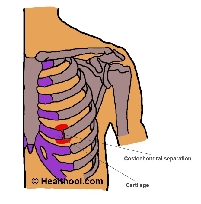 costochondral separation