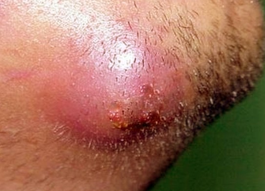 infected ingrown hair picture