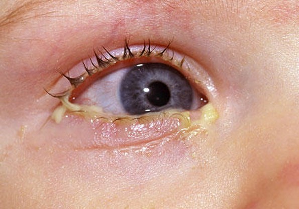 mucus in eye