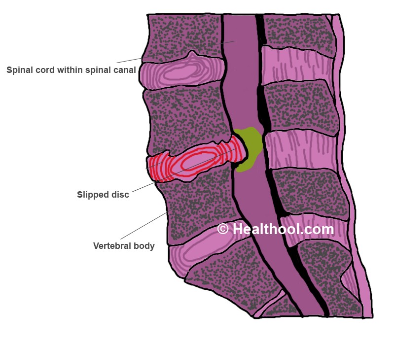 cervical retrolisthesis