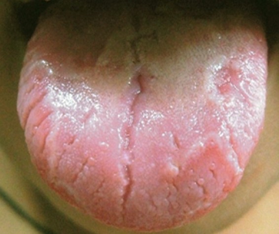scrotal tongue picture