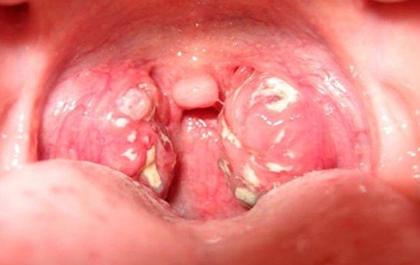 tonsillitis