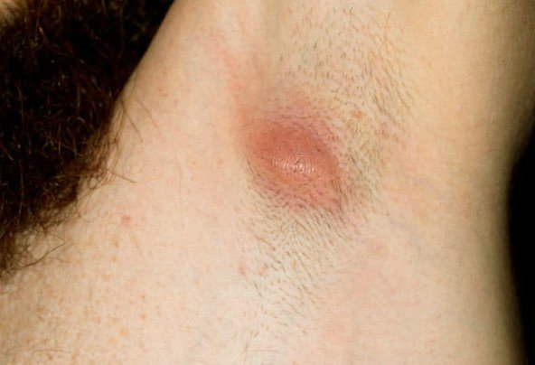 Underarm Cyst - Symptoms, Treatment, Pictures, Home 