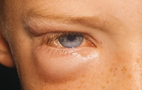 A noticeable swelling under the left eye.image