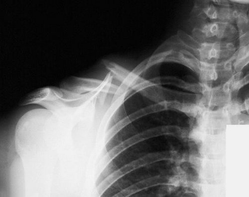 a group I clavicle fracture.image