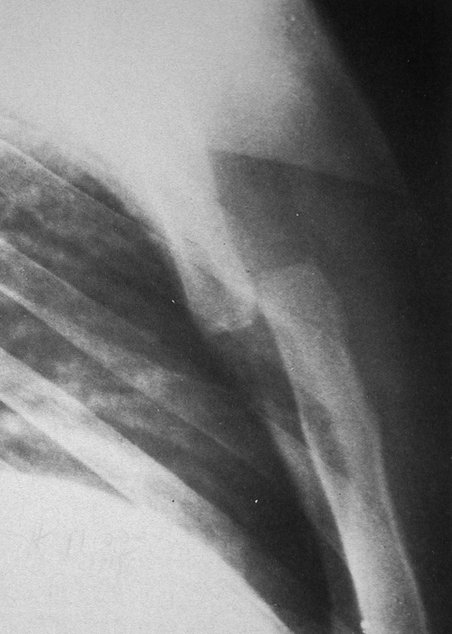 a lateral radiography of a fractured sternum.picture
