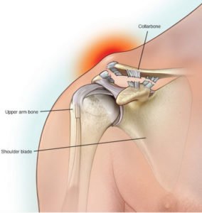 Collarbone Pain clavicle Pain Causes And Treatment November 2021 collarbone-pain-clavicle-pain-causes-and-treatment-november-2021