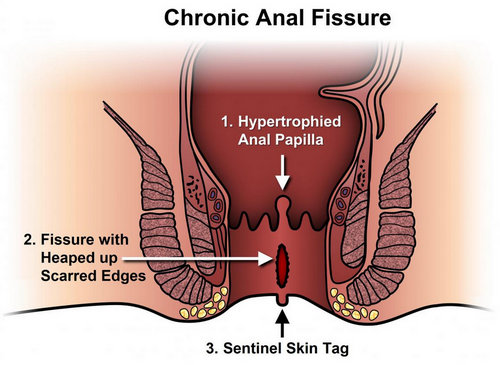 anal fissure..image