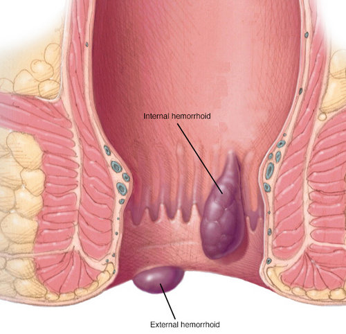 both internal and external hemorrhoids which are simply the anal or rectal blood vessels which are swollen and weak.picture