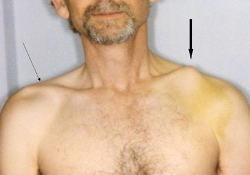 compare the right and left clavicle bones and see that one is notable higher.picture