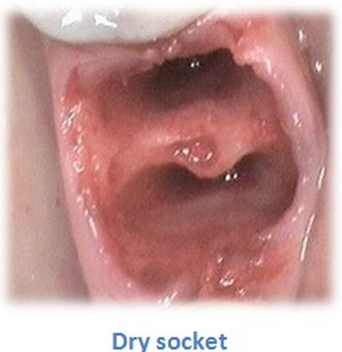 dry socket symptoms.figure