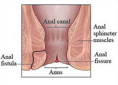 how and anal fistula appears.image