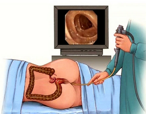 how the lower GI colonoscopy is done and how the doctor can monitor the inside of the colon.image