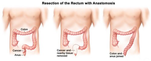 how the removal of the rectum will look.picture