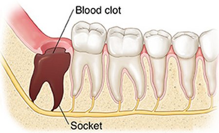 the blood clot fills the socket and protects the bone as well as the nerve.image