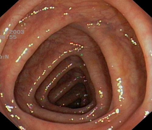 the passage of the splenic flexure during a routine colonoscopy.photo