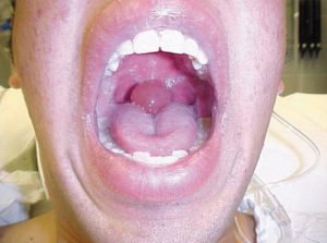 Swollen Uvula - Causes, Pictures, Remedies and Treatment - (2018 - Updated)