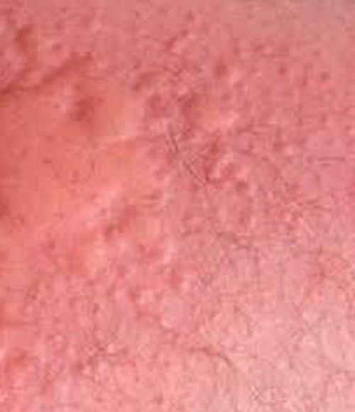 chlorine-rash-allergy-pictures-treatment-home-remedies-prevention