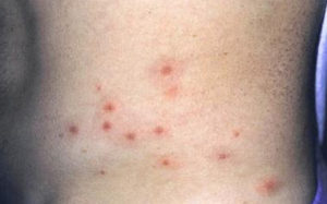 Healthoolchlorine rash on the side of the abdominal area.image | Healthool