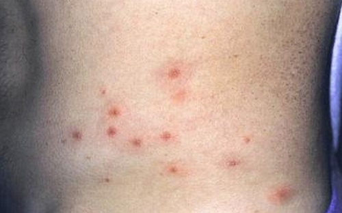 chlorine rash on the side of the abdominal area.image