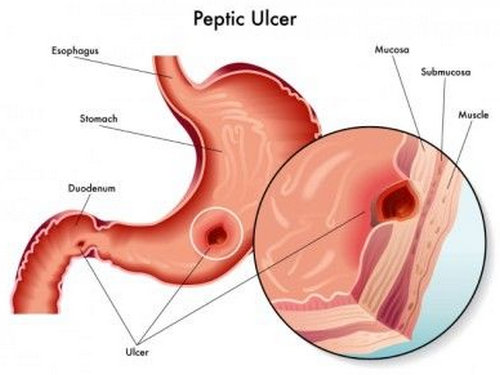 Peptic ulcer, one of the common reasons for GI bleeding leading to melena.picture
