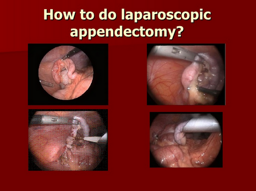 A step by step procedure on how to do a laparoscopic appendectomy.image