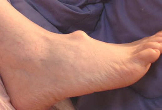 An example of foot exostosis or saddle bone deformity.image