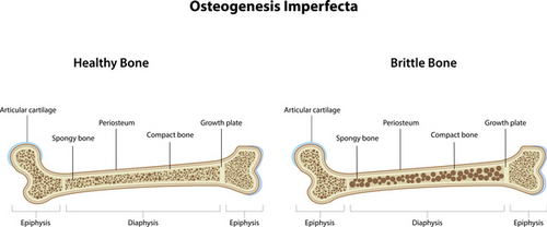 An image comparison of a healthy bone and a bone with osteogenesis imperfecta brittle bone disease.photo