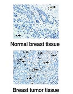 An image of a normal breast tissue and breast tumor tissue.photo