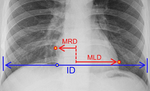 A chest x-ray film showing cardiothoracic ratio.image