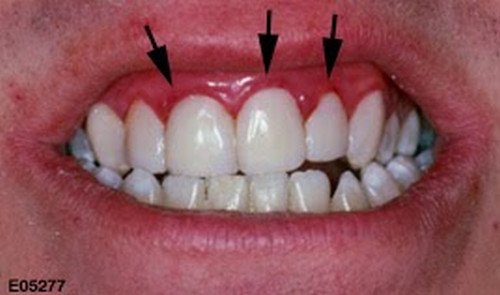 A closer look on the oral cavity of a patient with a mild swelling of the gums.photo