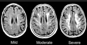 👉 Microvascular Ischemic Disease