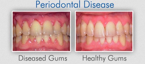 A comparison image of a healthy gum and a gum with periodontal disease.image