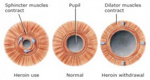 A comparison image showing a normal sized pupil, constricted pupil (secondary to heroin use), and dilated pupil indicating substance withdrawal.picturesA comparison image showing a normal sized pupil, constricted pupil (secondary to heroin use), and dilated pupil indicating substance withdrawal.pictures